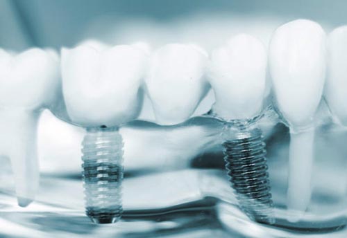 implant-dentar-in-Bucuresti